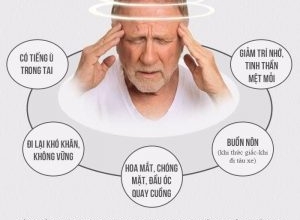 Các biểu hiện của bệnh tai biến mạch máu não, yếu tố nguy cơ gây tai biến mạch máu não